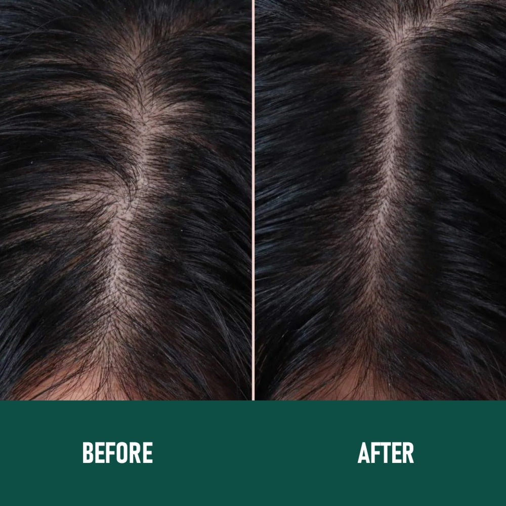 CH004 Minoxidil Anti-Hair Loss Mousse LadyShow.Store