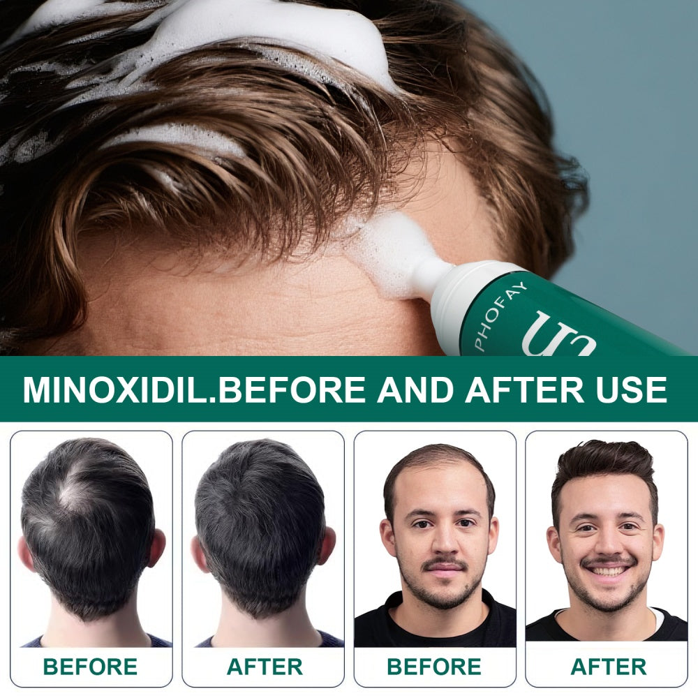 CH004 Minoxidil Anti-Hair Loss Mousse LadyShow.Store