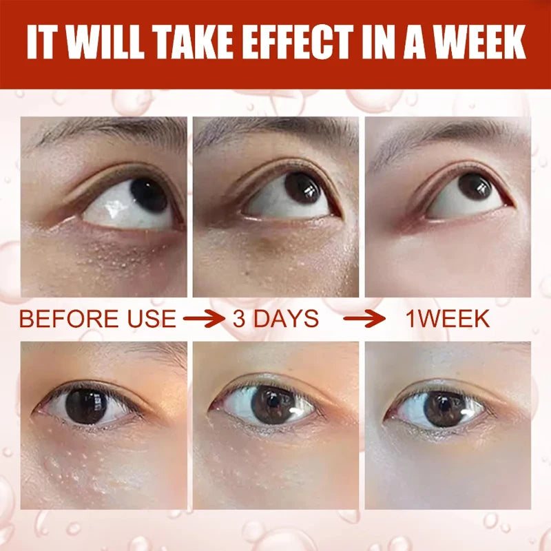 Fat Granules Removal Eye Serum Eye Milia Repair Treatment Products Wrinkle Lifting Moisturizing Anti-Puffiness Korean Skin Care Pi-Mart