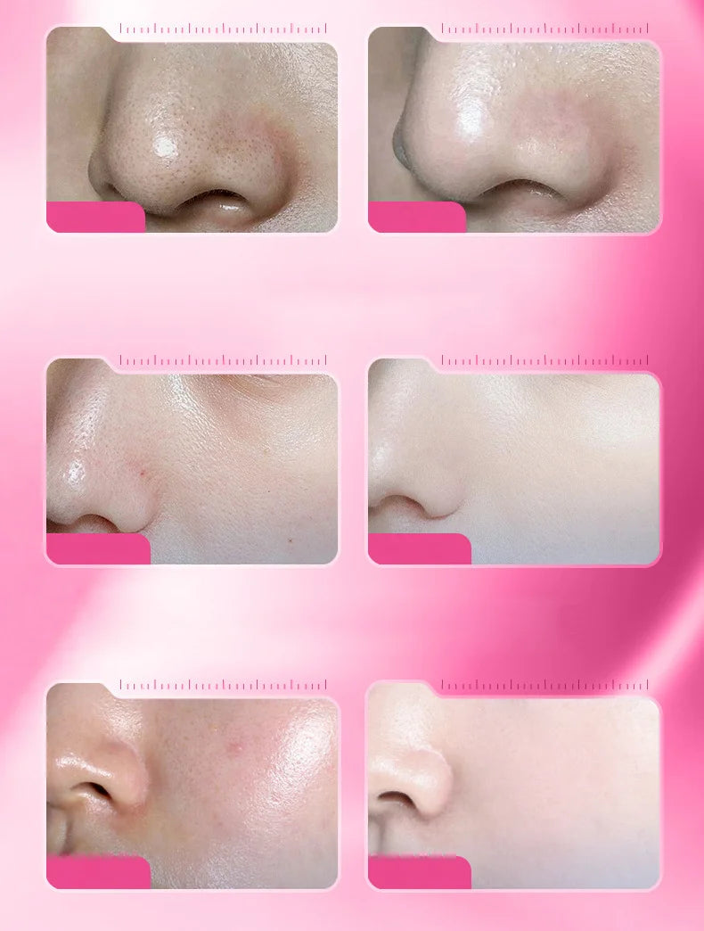 100ml Pink Salicylic Acid Acne Removing Concentrated essence - Refreshing texture, deep moisturizing, fade acne marks Pi-Mart