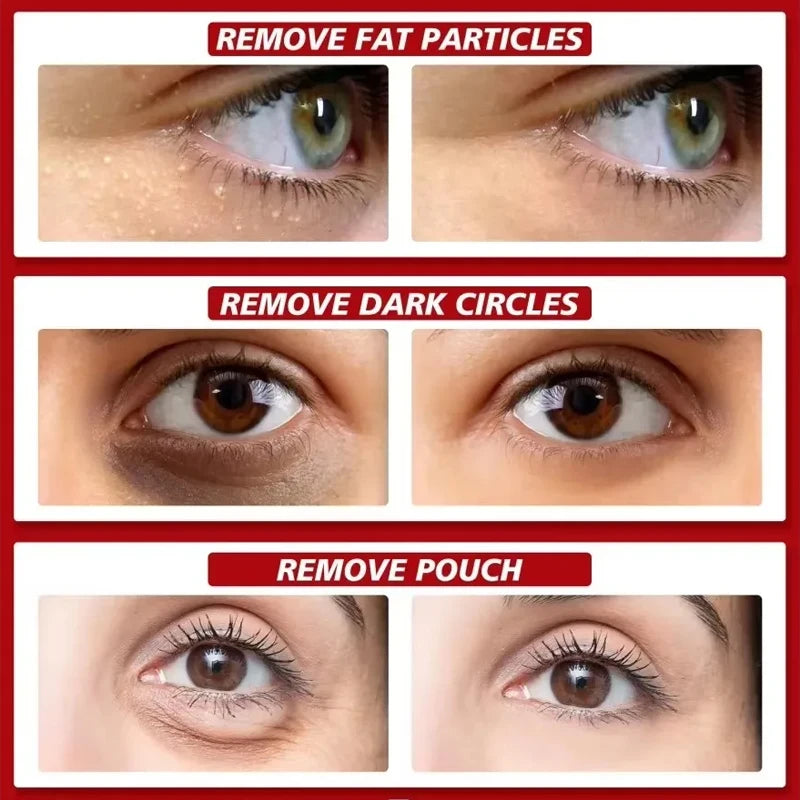 Fat Granules Removal Eye Serum Eye Milia Repair Treatment Products Wrinkle Lifting Moisturizing Anti-Puffiness Korean Skin Care Pi-Mart