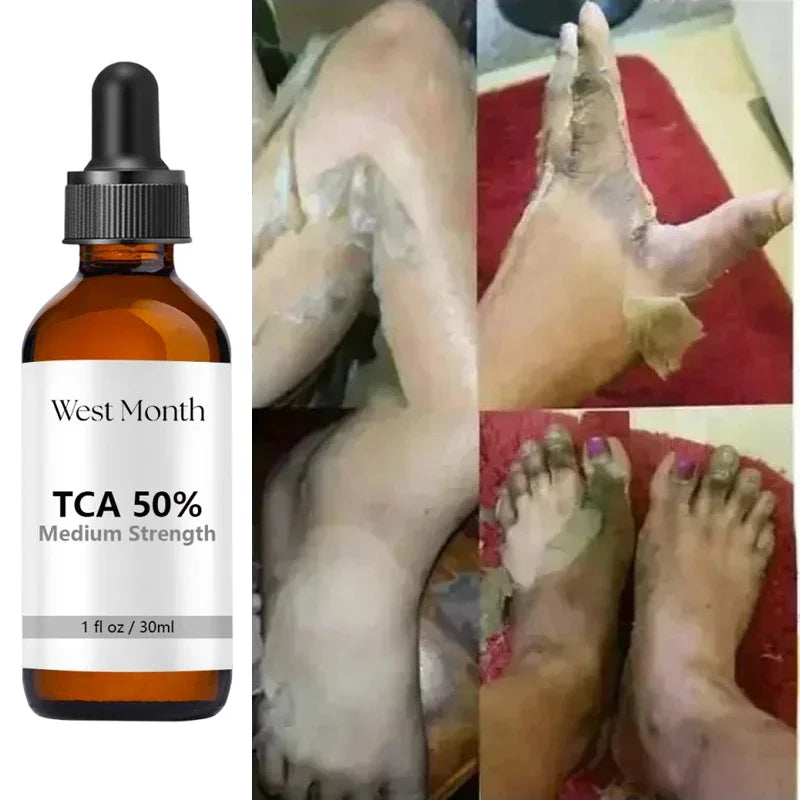 Acid Peeling Serum Chemical Exfoliant Peel For Remove Face Dark Skin Spots Whiten Lighten Melanin Peeling Solution Skin Peel Pi-Mart