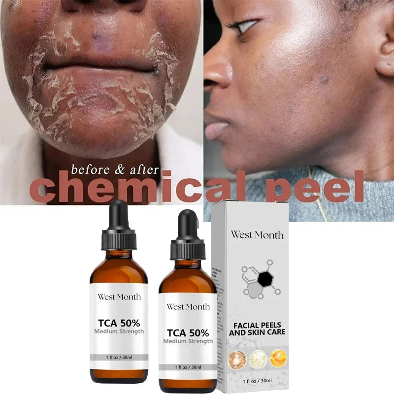 Acid Peeling Serum Chemical Exfoliant Peel For Remove Face Dark Skin Spots Whiten Lighten Melanin Peeling Solution Skin Peel Pi-Mart