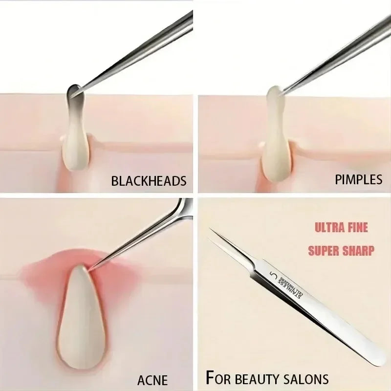 German 1/3/8Pack Extra Fine No. 5 Cellular Acne Blackhead Tweezers - Facial Beauty Remove Acne Needle Tools for Skin Care Tools Pi-Mart