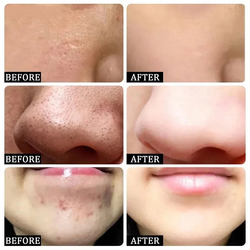 Remove Large Pores Serum Salicylic Acid Facial Pore Shrinking Tightening Pore Minimizing Firming Smooth Essence Korean Skin Care Pi-Mart