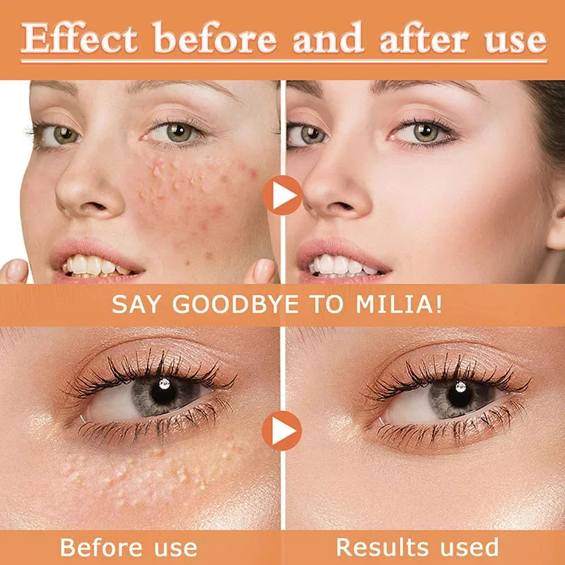 Fat Granules Removal Eye Serum Eye Milia Repair Treatment Products Wrinkle Lifting Moisturizing Anti-Puffiness Korean Skin Care Pi-Mart
