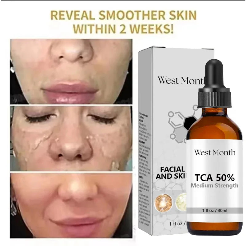Acid Peeling Serum Chemical Exfoliant Peel For Remove Face Dark Skin Spots Whiten Lighten Melanin Peeling Solution Skin Peel Pi-Mart