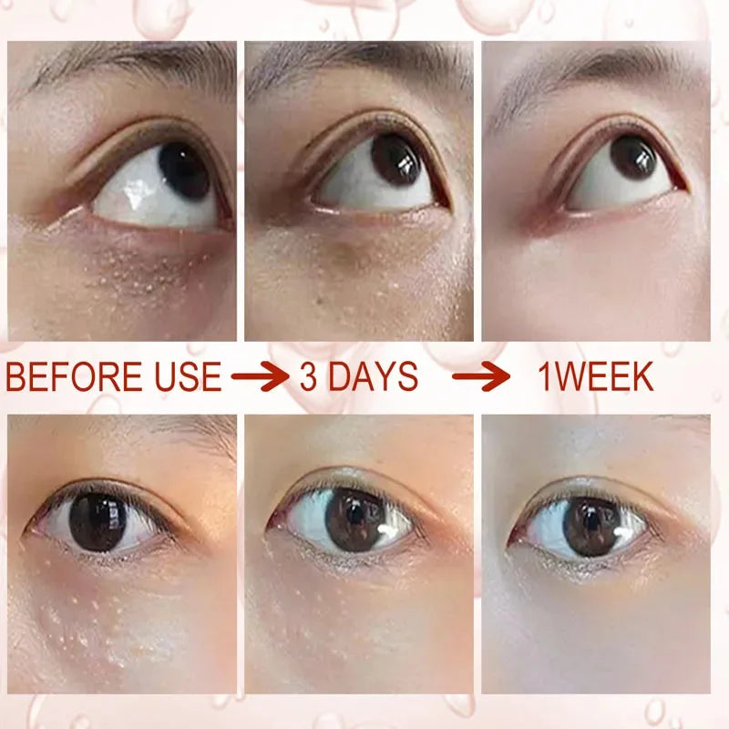 Fat Granules Removal Eye Serum Eye Milia Repair Treatment Products Wrinkle Lifting Moisturizing Anti-Puffiness Korean Skin Care Pi-Mart