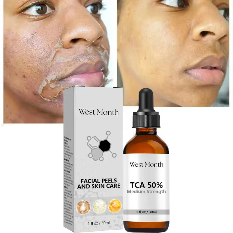 Acid Peeling Serum Chemical Exfoliant Peel For Remove Face Dark Skin Spots Whiten Lighten Melanin Peeling Solution Skin Peel Pi-Mart