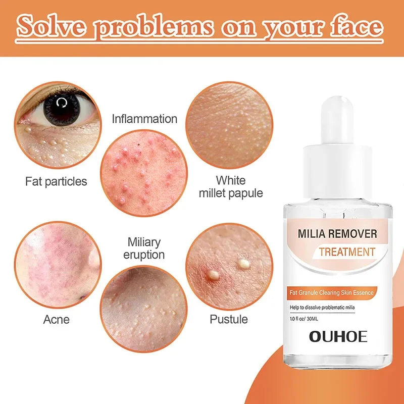 Fat Granules Removal Eye Serum Eye Milia Repair Treatment Products Wrinkle Lifting Moisturizing Anti-Puffiness Korean Skin Care Pi-Mart