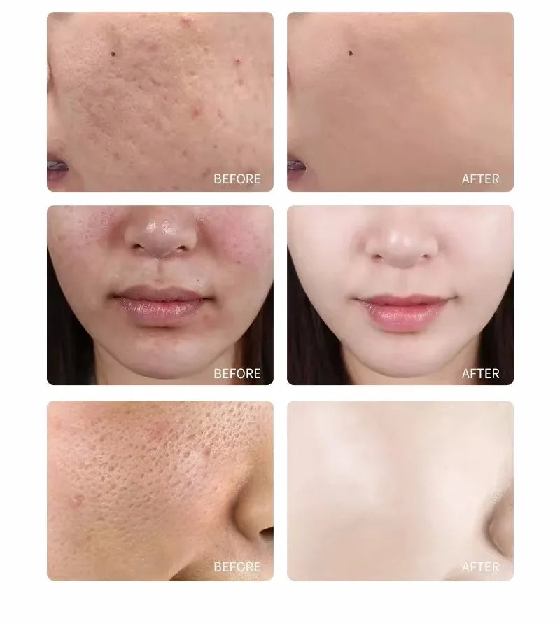 Acid Peeling Serum Chemical Exfoliant Peel For Remove Face Dark Skin Spots Whiten Lighten Melanin Peeling Solution Skin Peel Pi-Mart